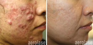 aerolase acne 5 treatments