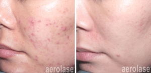 aerolase acne spade before after watermark 6 treatments