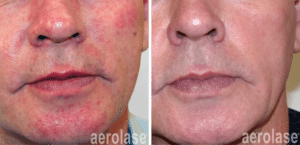 aerolase neoskin Rosacea After 2 Treatments