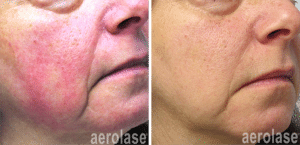 aerolase rosacea 1 treatment